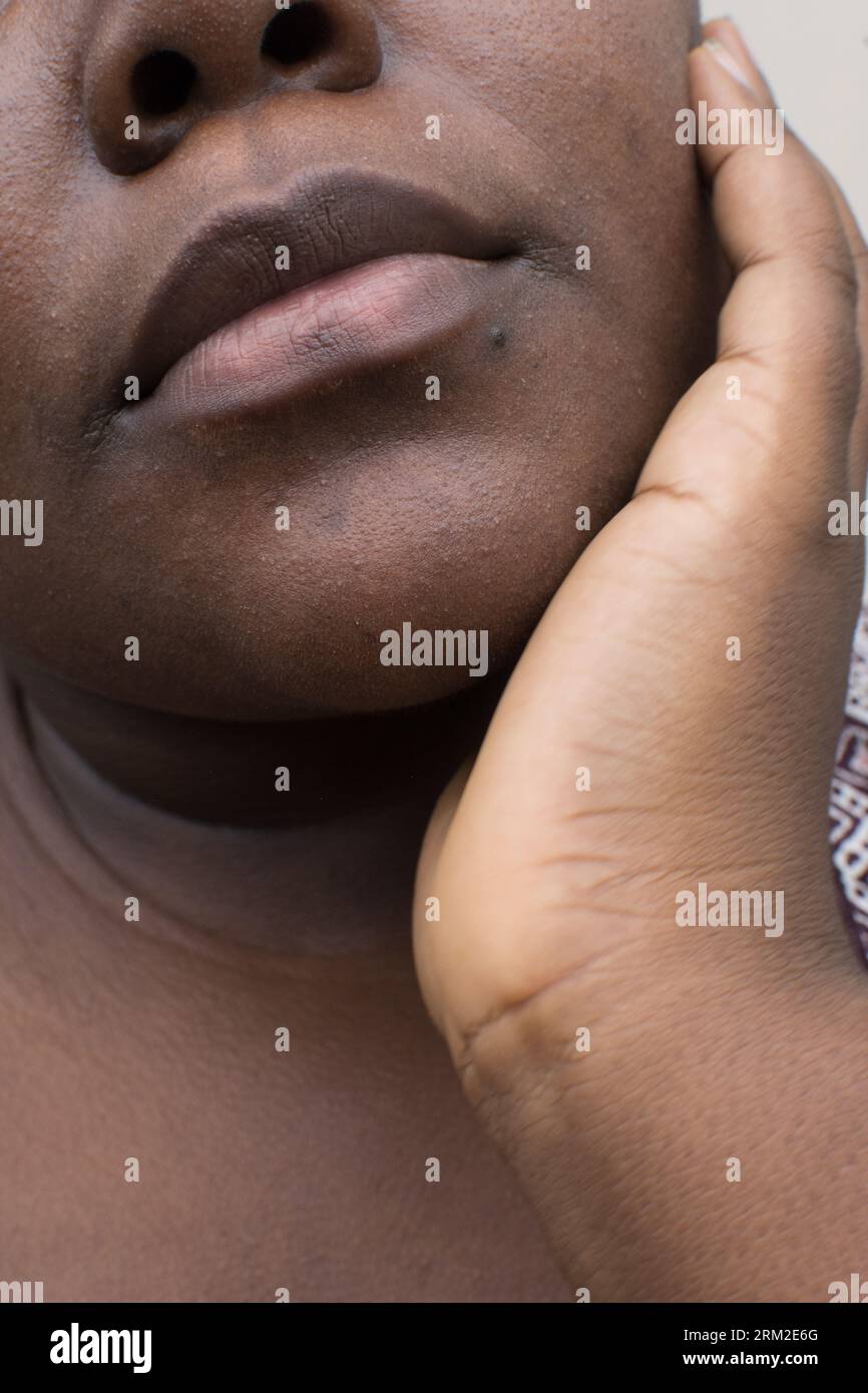 Brown skin with dark spots, hyperpigmentation on brown skin, african american woman with skin blemishes, imperfect skin Stock Photo