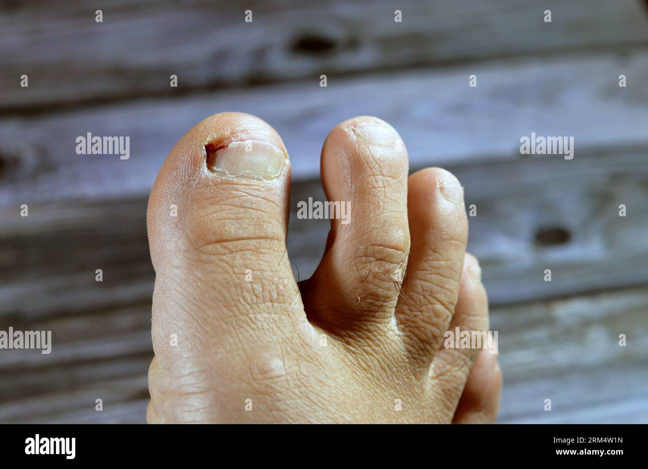 Bleeding of the big toe of the right foot, insult of the foot toe resulting in a bleeding wound that needs care and bandage, blood on toenail that nee Stock Photo