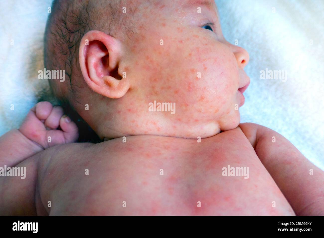 baby allergy skin. child dermatitis symptom problem rash. suffering