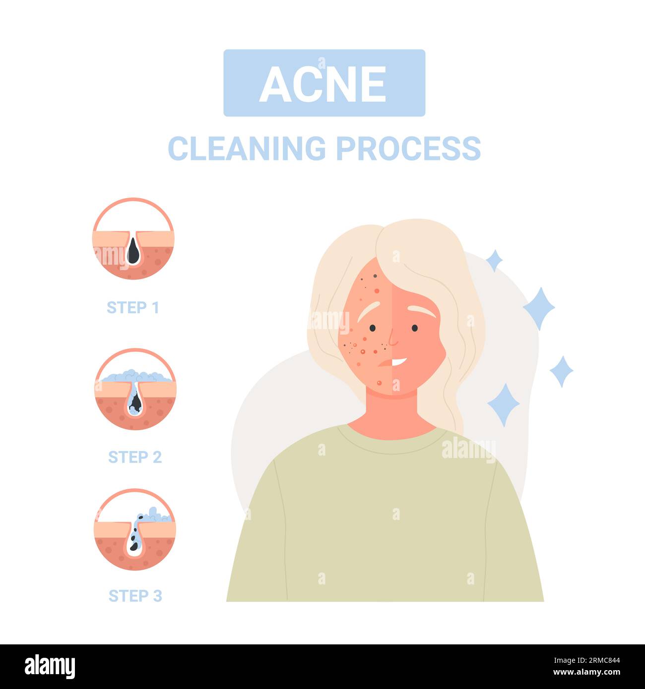 Steps for cleaning process against skin acne. Correct acne treatment, pores washing up process flat vector illustration Stock Vector