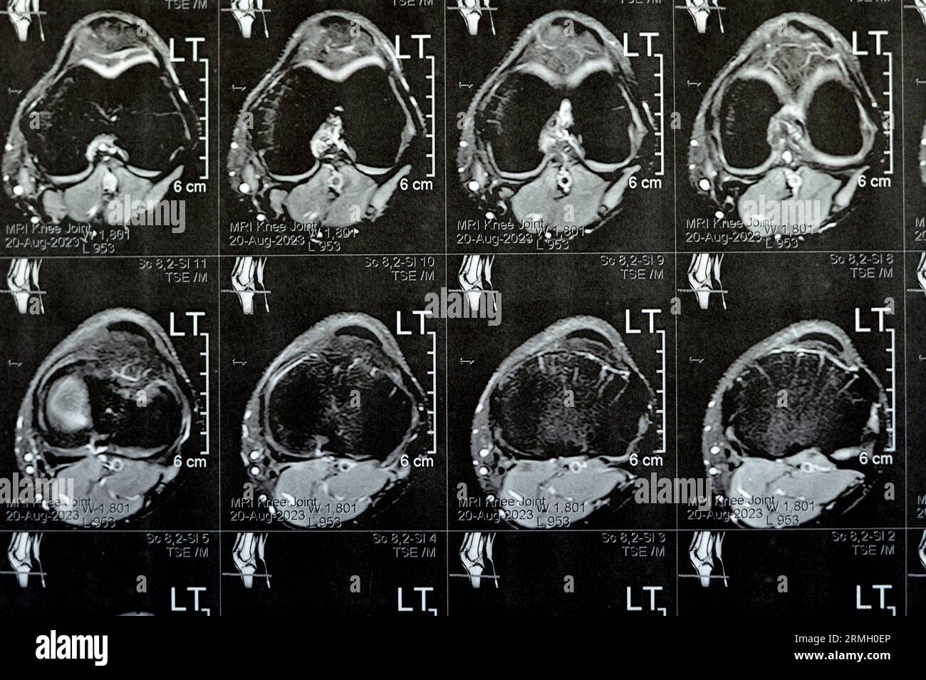 MRI of left knee joint showing minimal joint effusion, PHMM Posterior