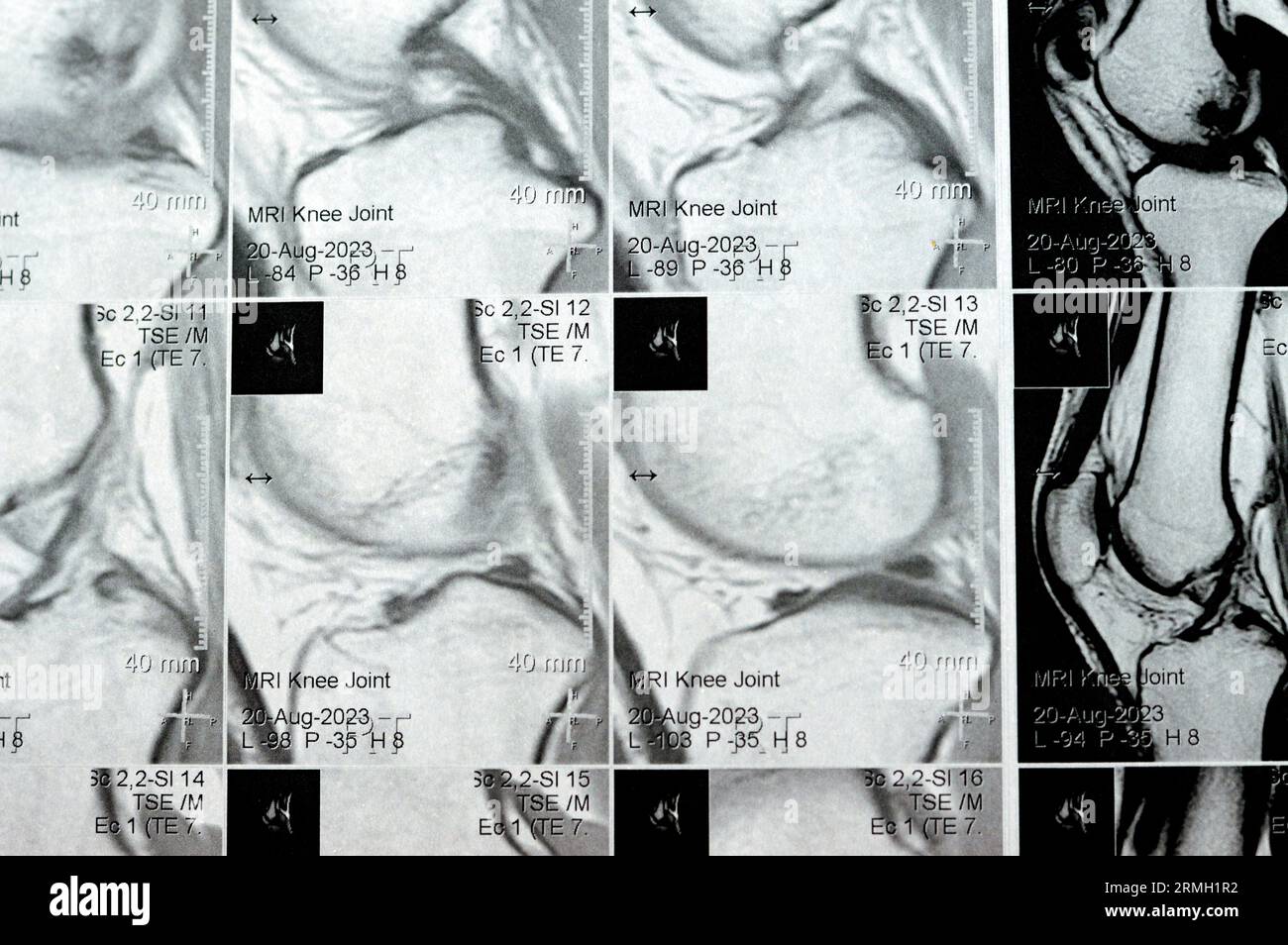 MRI of the right knee showing mild joint effusion, with normal other findings of PHMM, ACL, MCL, LCL, LM, ligaments, patella, tendons, nerves, muscles Stock Photo