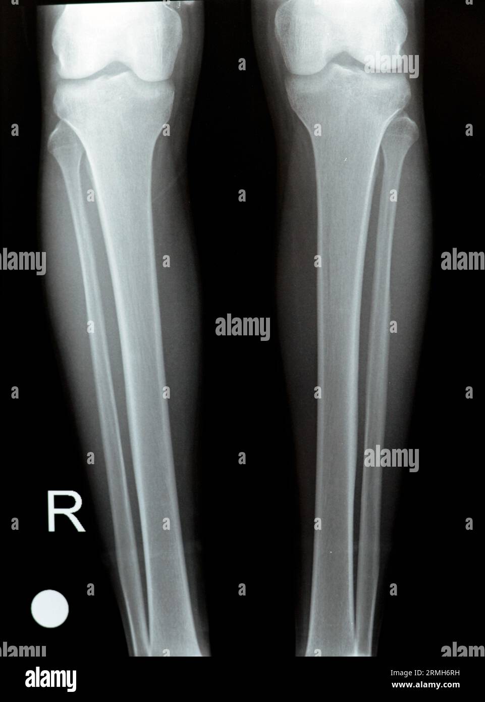 Plain X ray of both right and left knee joints with lower part of femur