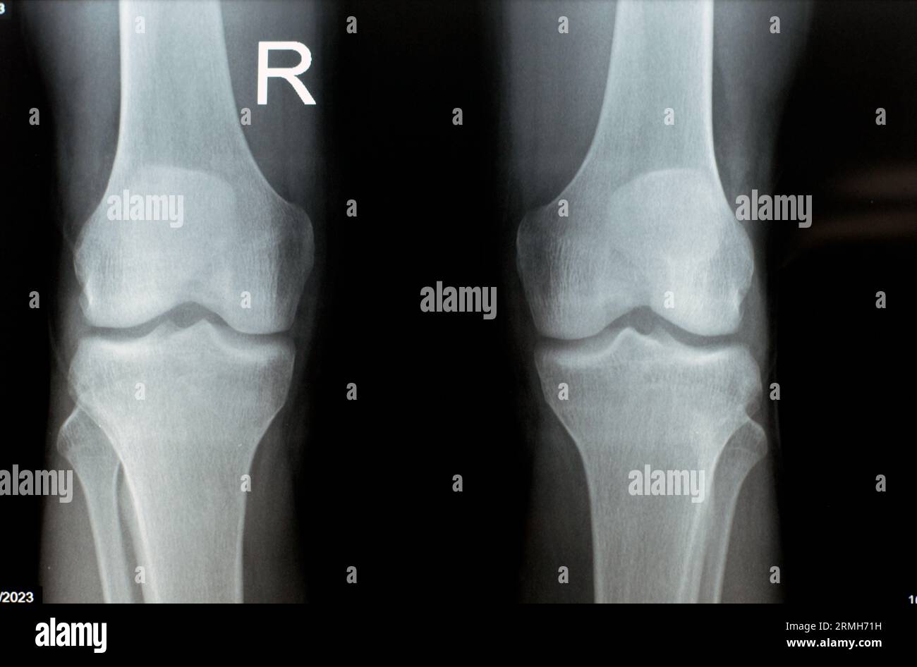 Plain X ray of both right and left knee joints with lower part of femur and upper parts of tibia and fibula and patella showing normal knee join of a Stock Photo