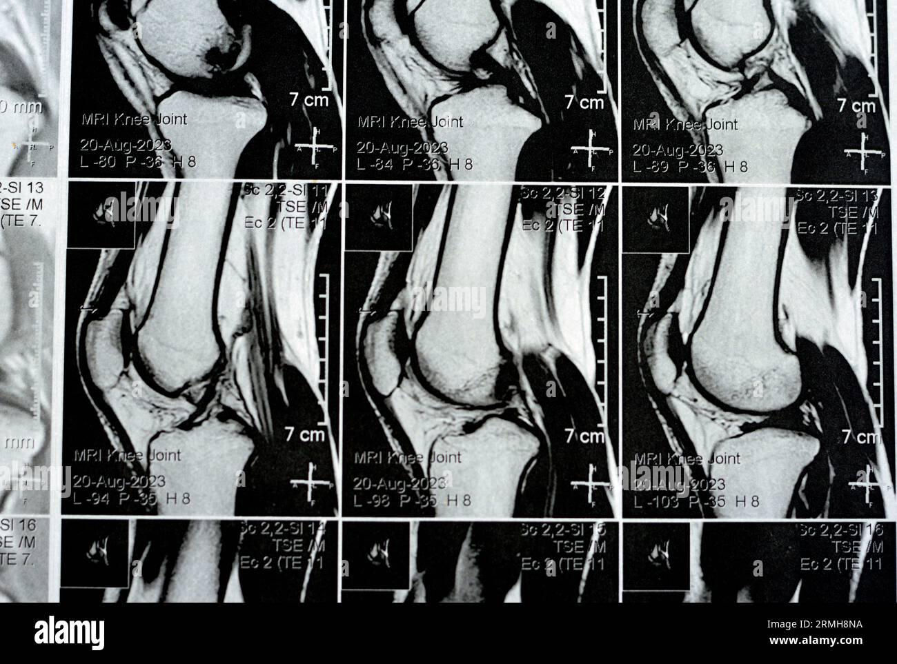 MRI of the right knee showing mild joint effusion, with normal other findings of PHMM, ACL, MCL, LCL, LM, ligaments, patella, tendons, nerves, muscles Stock Photo