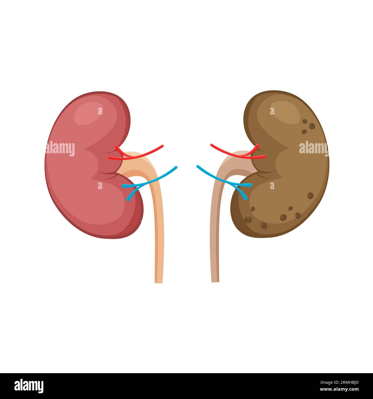 Normal healthy and unhealthy polycystic kidneys. Polycystic kidney ...