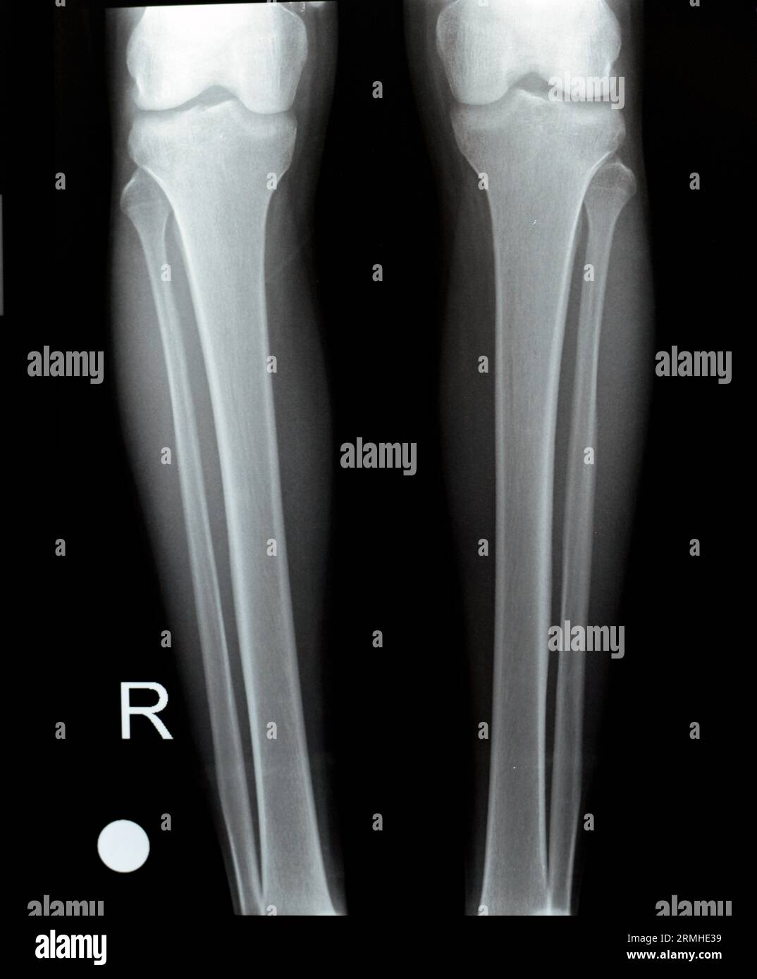 Normal knee x ray hires stock photography and images Alamy