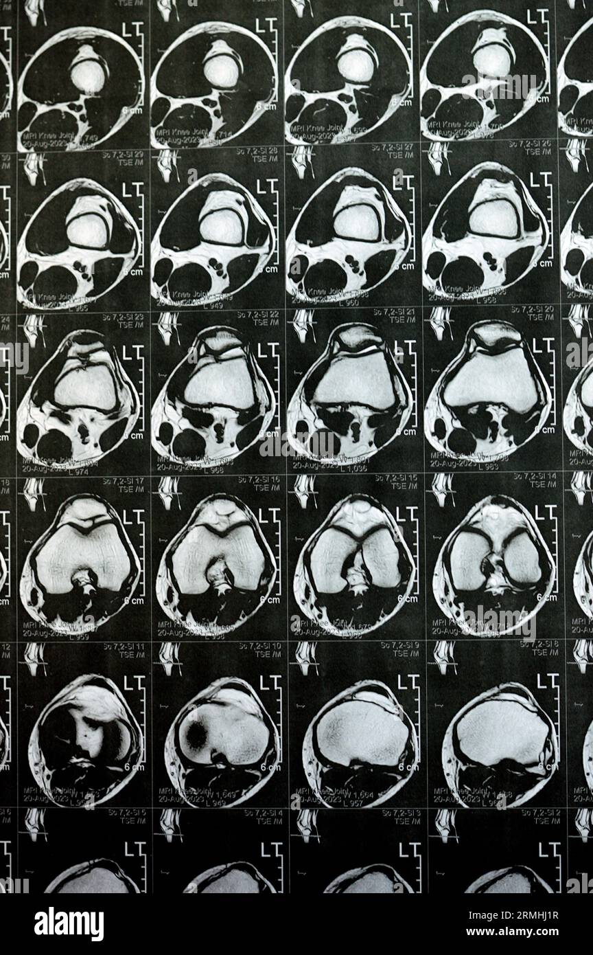 MRI of left knee joint showing minimal joint effusion, PHMM Posterior