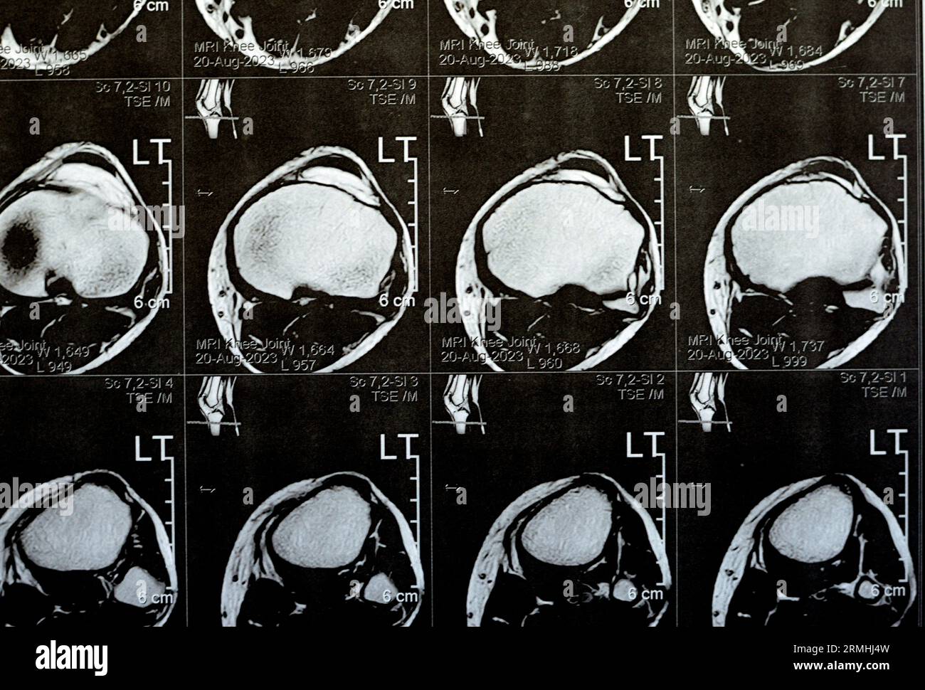 MRI of left knee joint showing minimal joint effusion, PHMM Posterior