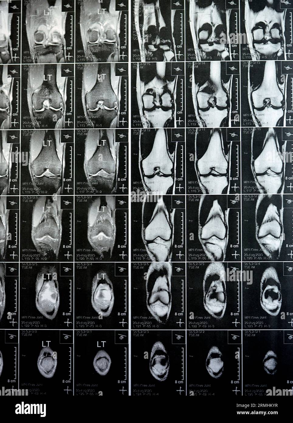 MRI of left knee joint showing minimal joint effusion, PHMM Posterior