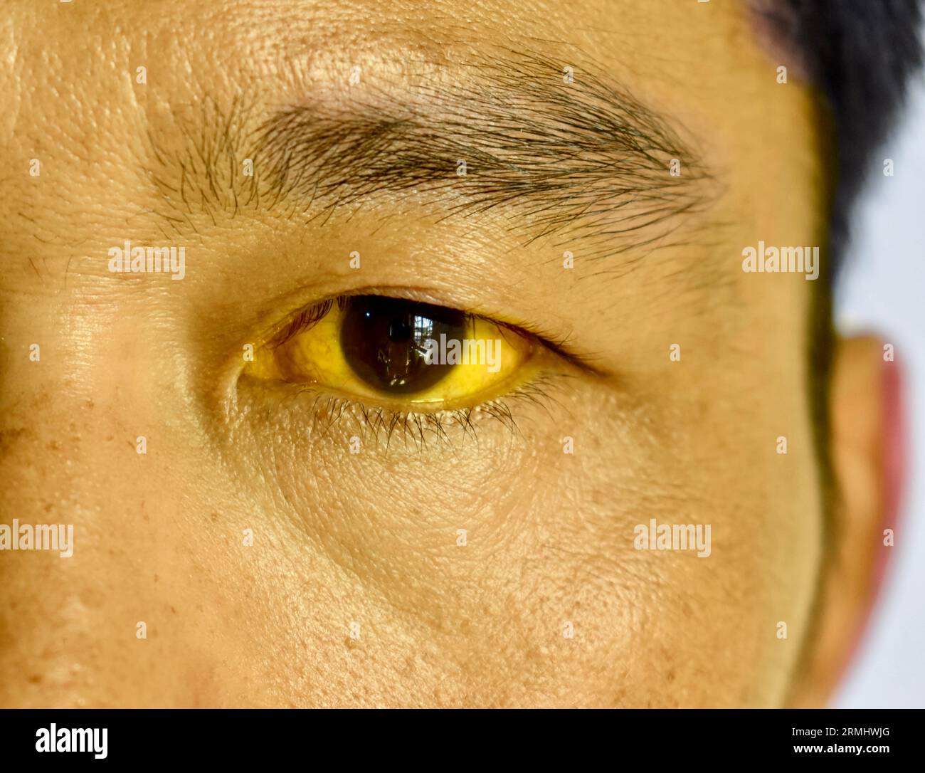 Deep jaundice in Asian male patient. Yellowish discoloration of skin and sclera. Hyperbilirubinemia. Acute hepatitis. Stock Photo