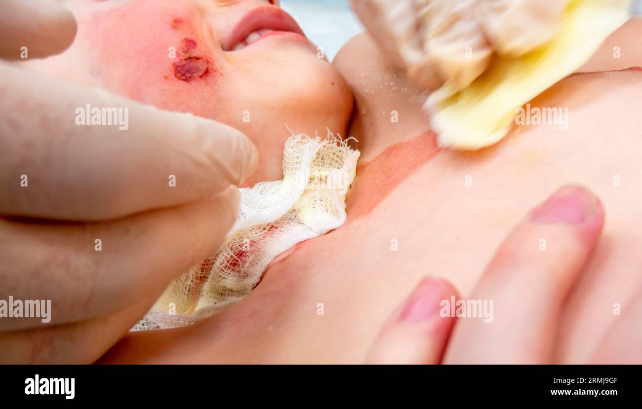 dressing a boy with a burn from boiling water Stock Photo Alamy