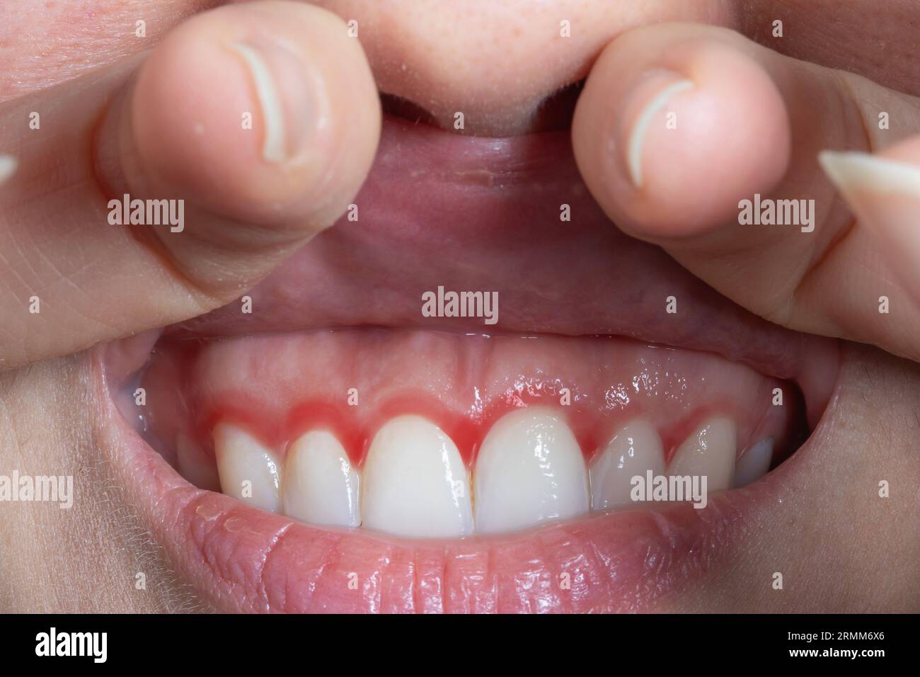 Macro of a woman's red gums. Gum inflammation with redness. Cropped shot of a young woman showing bleeding gums. Dentistry, dental care and oral hygie Stock Photo