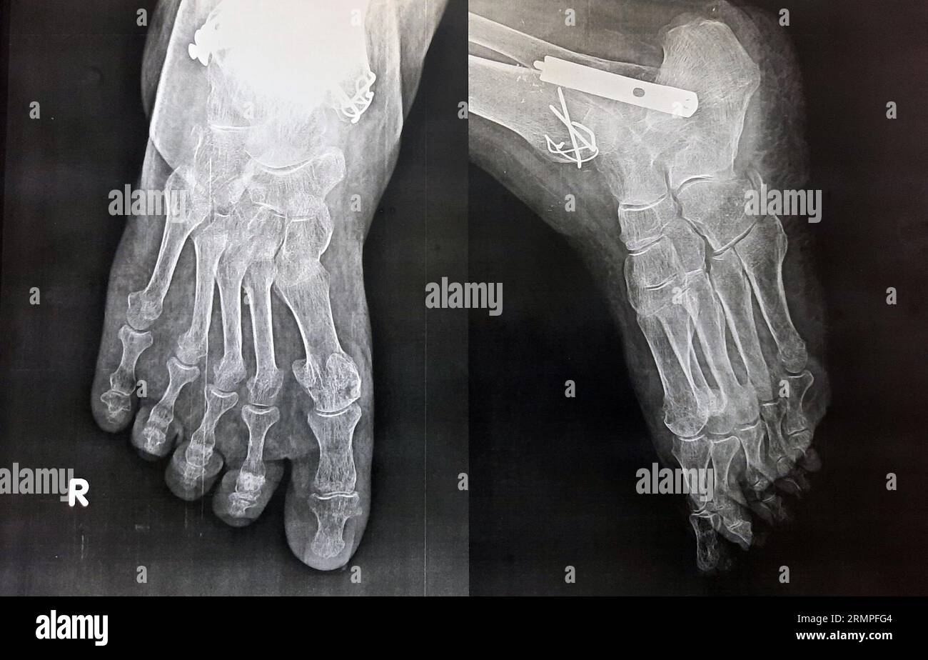 Plain x ray of the right foot of an old female patient with a new