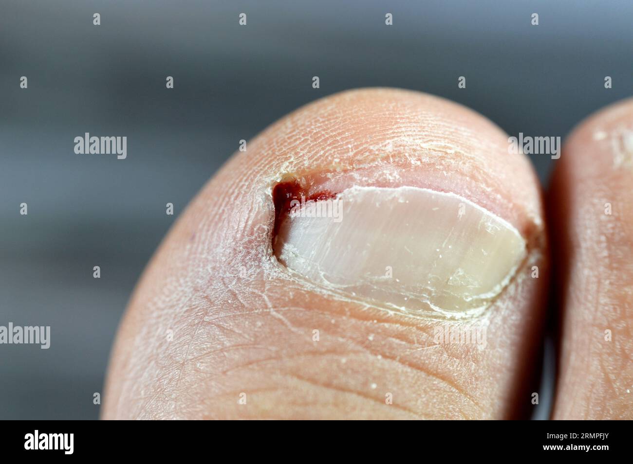 Bleeding of the big toe of the right foot, insult of the foot toe resulting in a bleeding wound that needs care and bandage, blood on toenail that nee Stock Photo