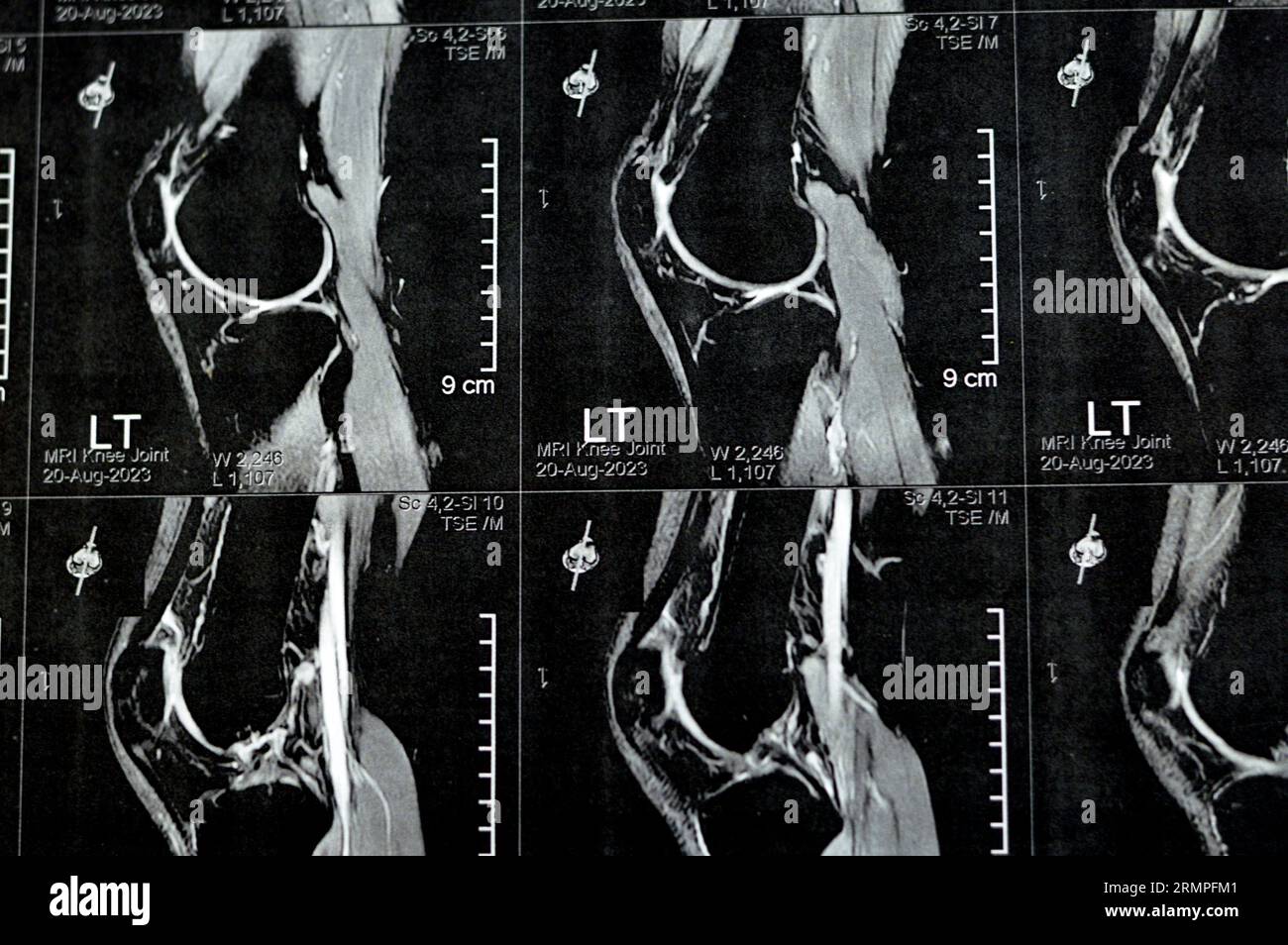 MRI of left knee joint showing minimal joint effusion, PHMM Posterior Horn Medial Meniscus degeneration, ACL anterior cruciate ligament mild sprain, n Stock Photo