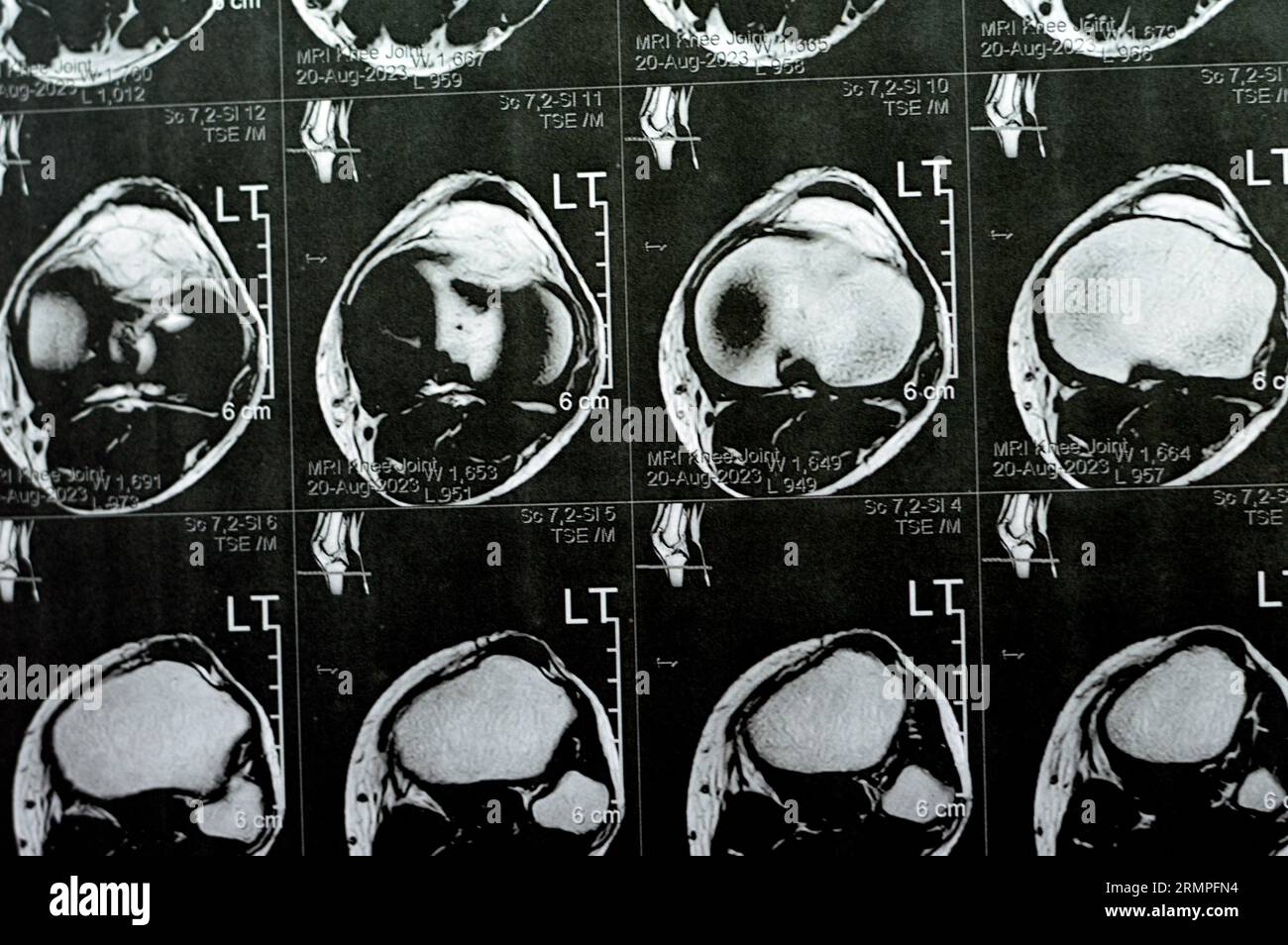 MRI of left knee joint showing minimal joint effusion, PHMM Posterior