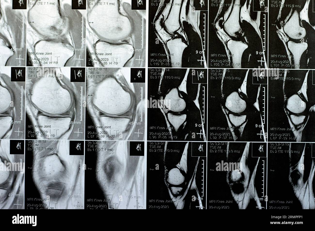MRI of left knee joint showing minimal joint effusion, PHMM Posterior Horn Medial Meniscus degeneration, ACL anterior cruciate ligament mild sprain, n Stock Photo