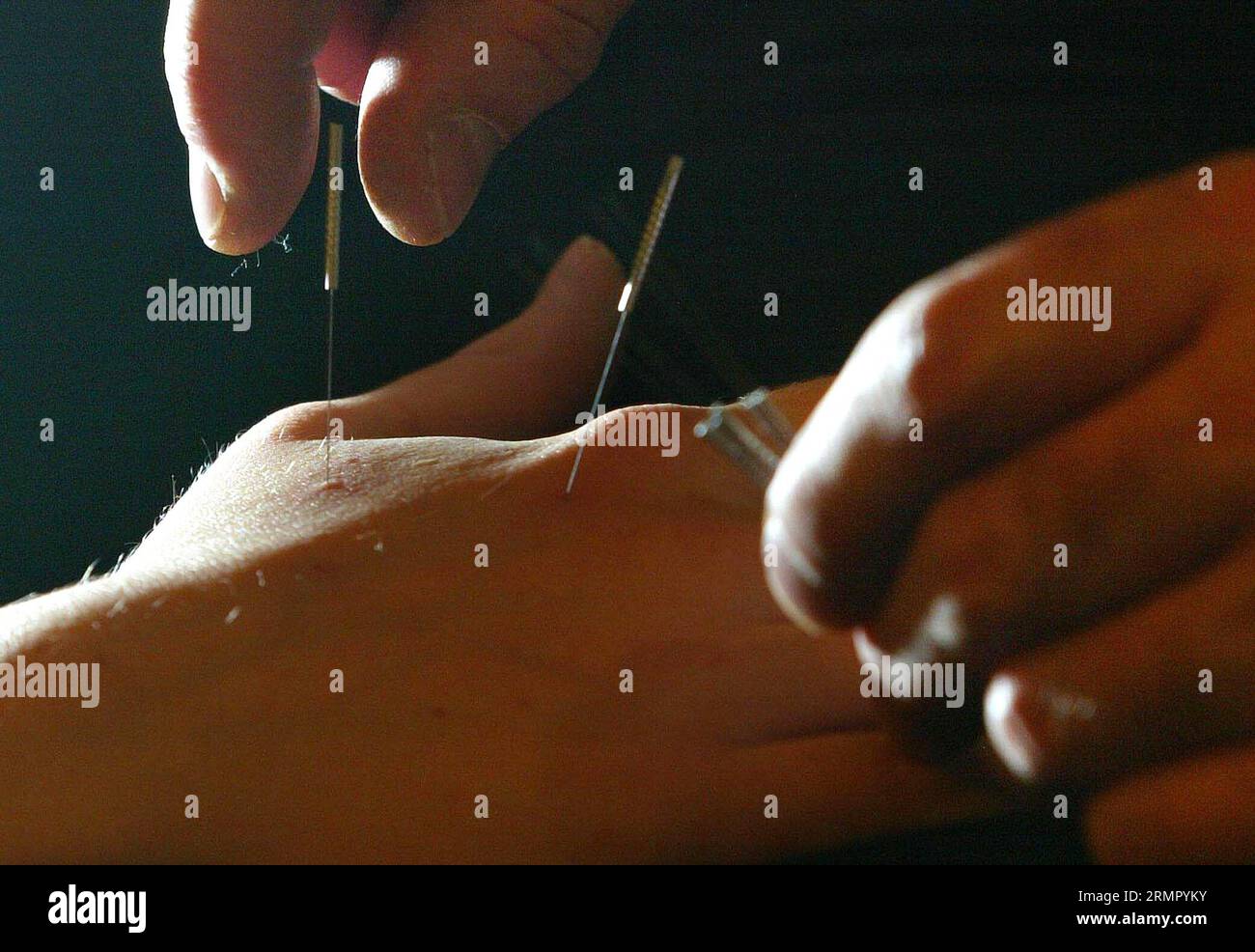 File photo dated 28/11/06 of acupuncture treatment, as three ads for acupuncture and craniosacral therapists have been banned for making misleading claims about their ability to treat long Covid. Stock Photo