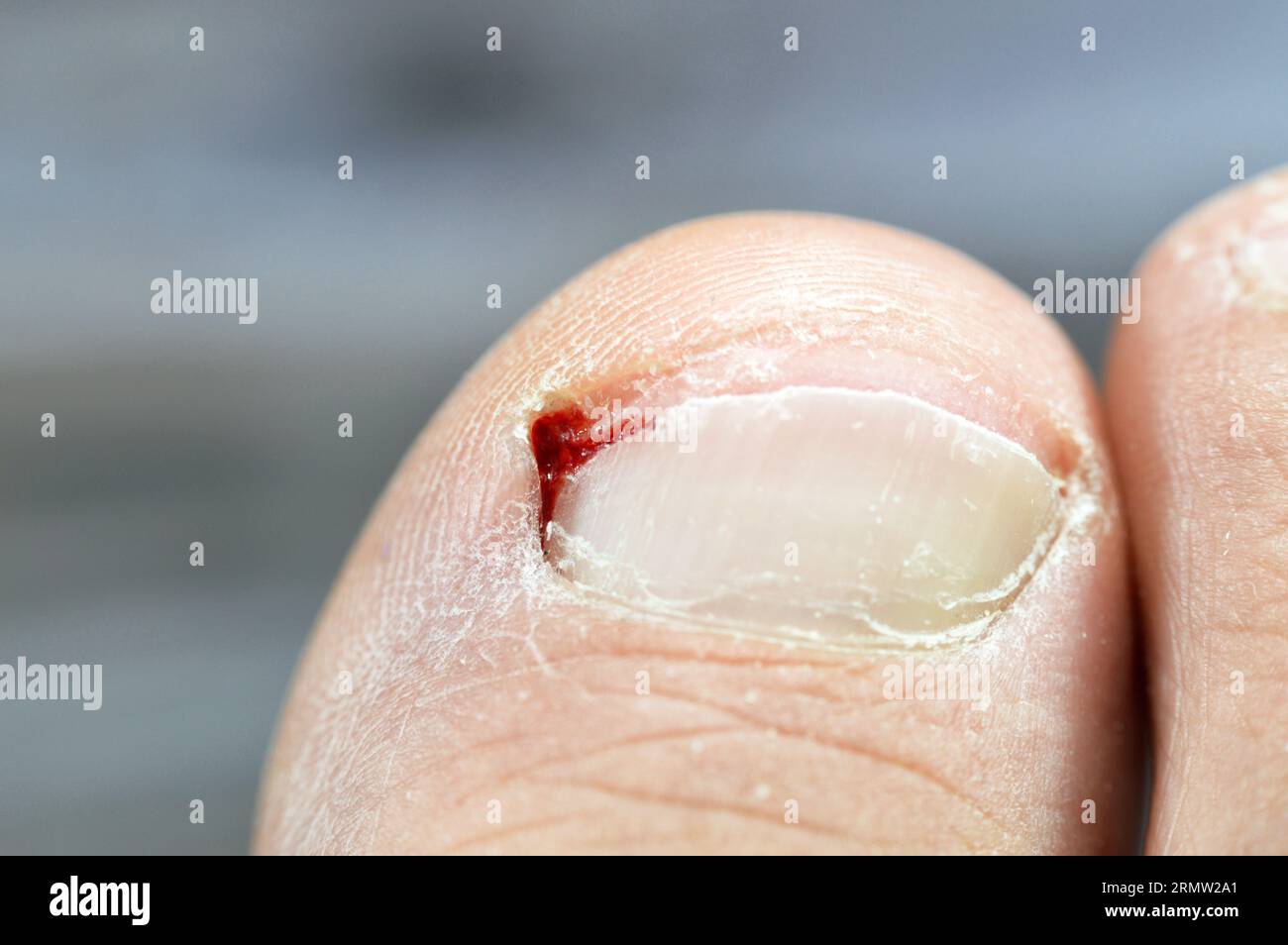 Bleeding of the big toe of the right foot, insult of the foot toe resulting in a bleeding wound that needs care and bandage, blood on toenail that nee Stock Photo