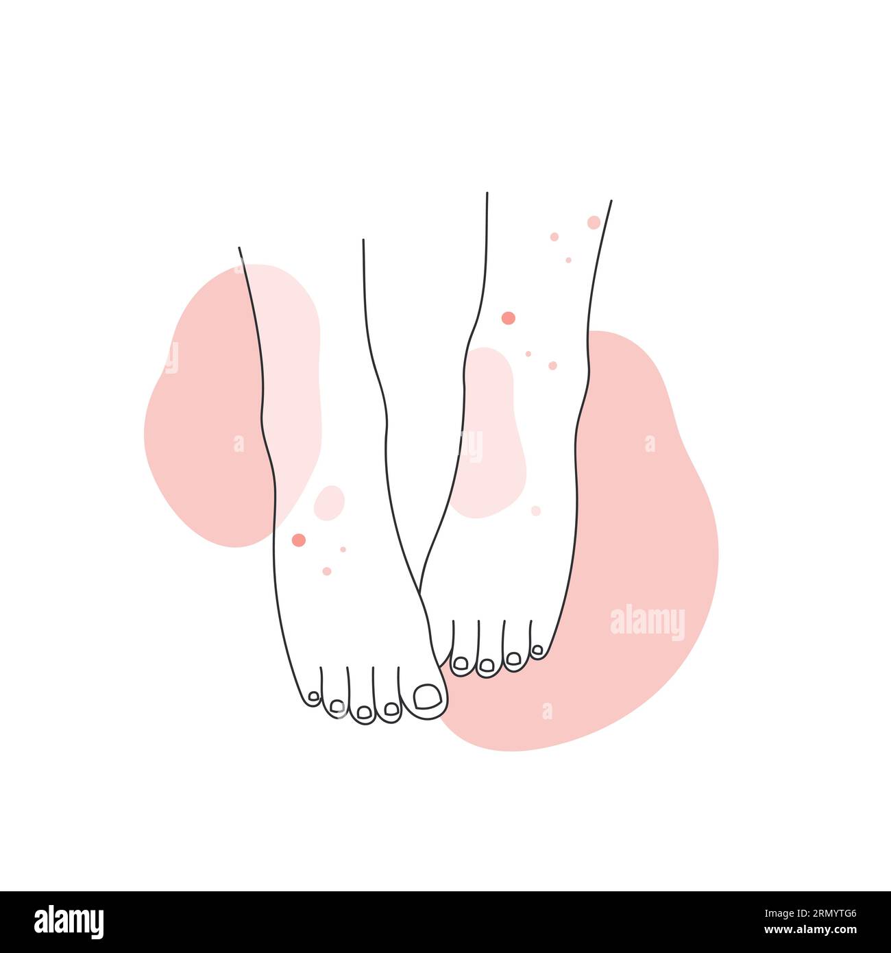 Human legs with skin allergy. Feet covered with red rash, atopic dermatitis line vector illustration Stock Vector