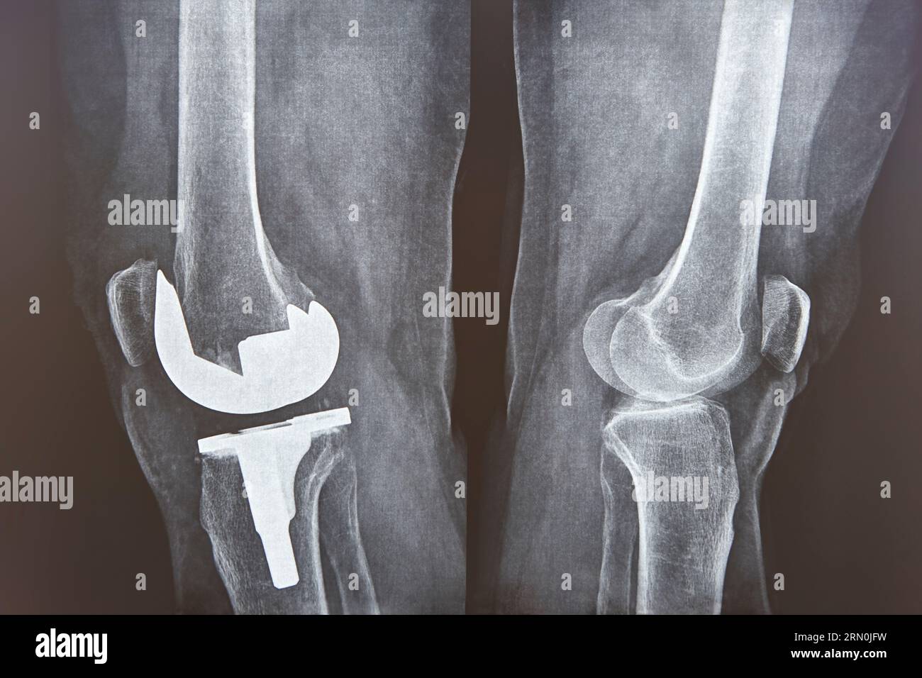 Knee cap replacement xrays. Titanium implant. Osteoarthritis. Articular