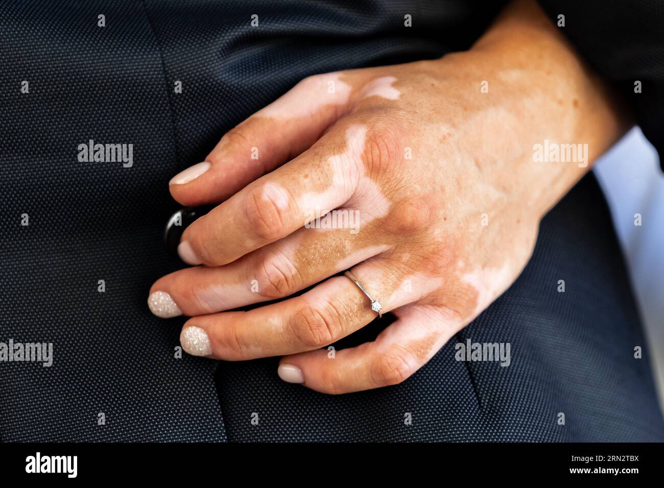 Woman hand with Vitiligo on fingers, isolated on black background
