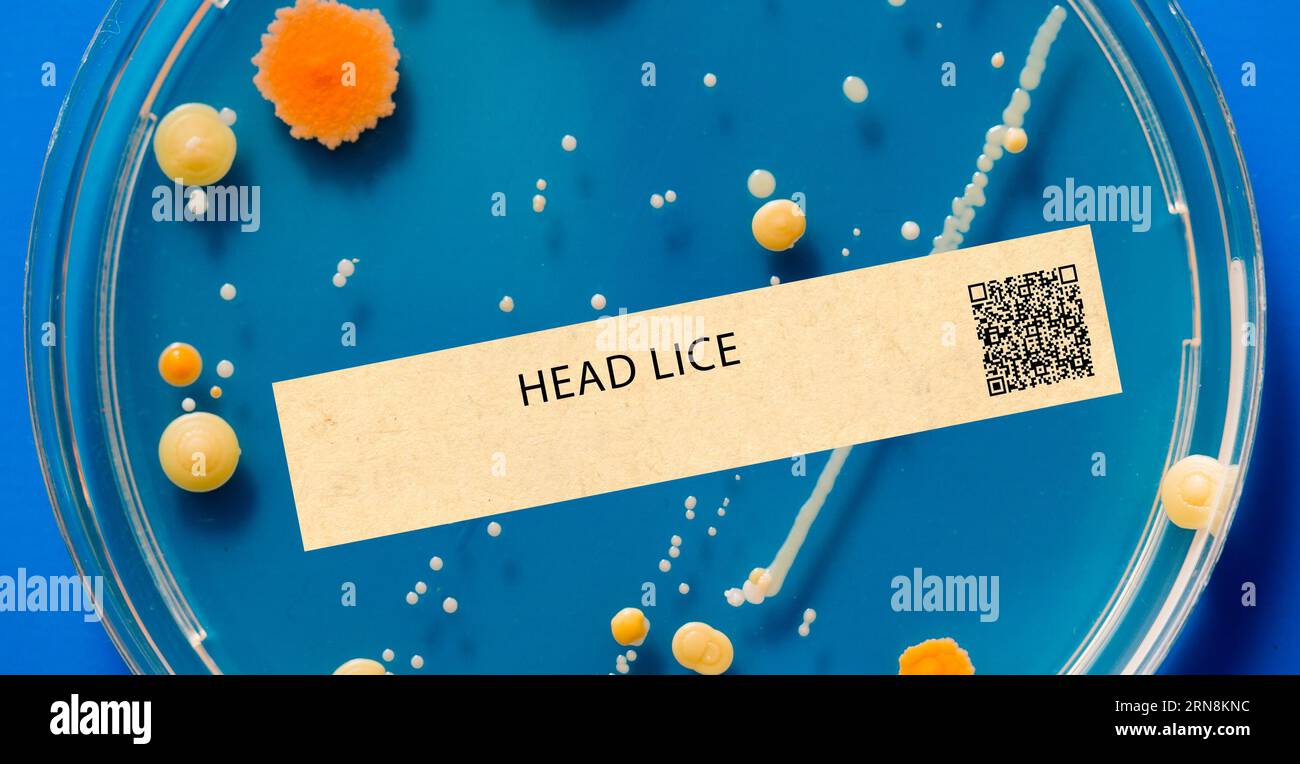 Head lice - Parasitic infection that affects the scalp and causes itching. Stock Photo