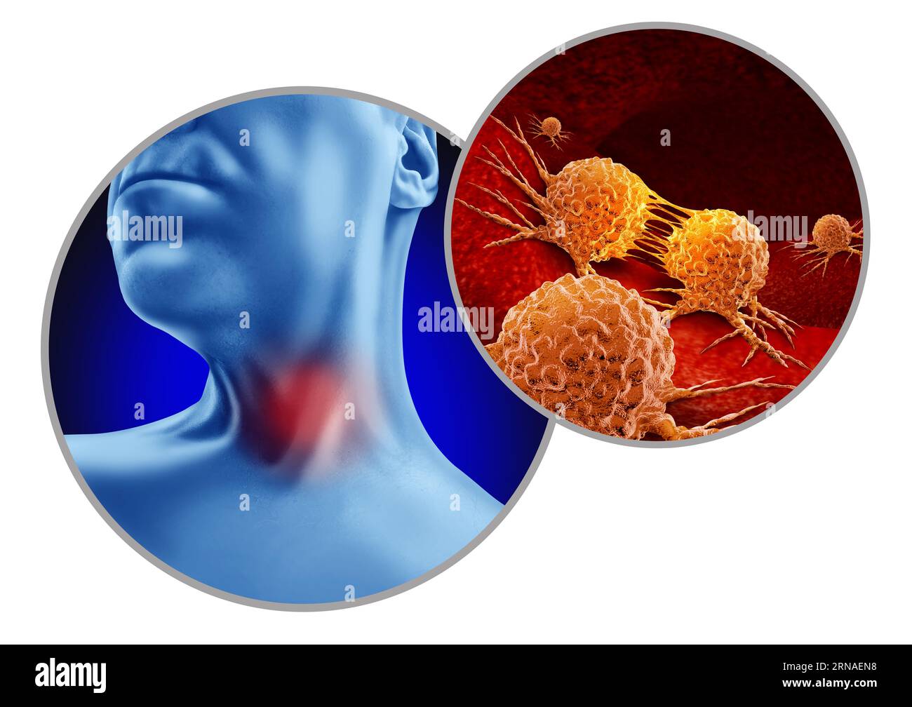 Throat Cancer as abnormal cell growth as aryngeal or pharyngeal and HPV related cancers as a patient with a tumor in the neck Stock Photo