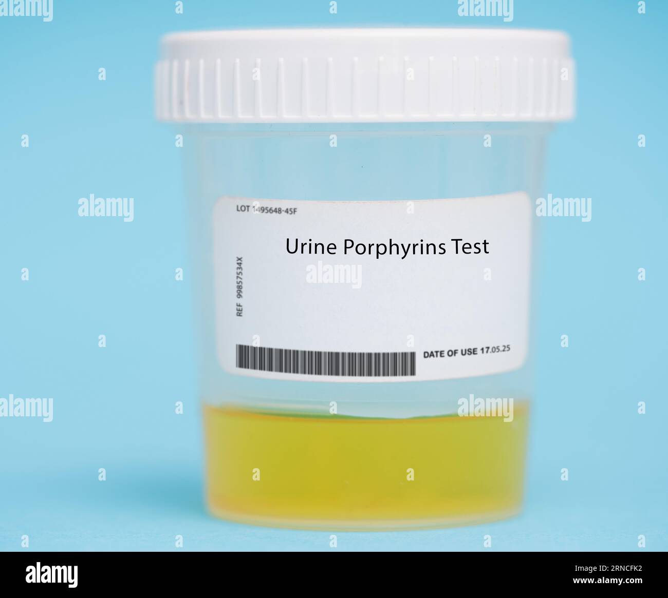 Urine porphyrins test This test measures the levels of porphyrins ...