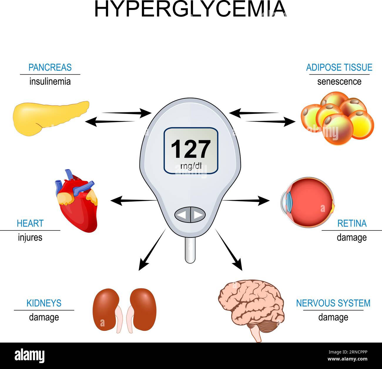 hyperglycemia. Insulin resistance. Relationship between senescence cell, High blood sugar level and complications of Diabetes mellitus. Vector illustr Stock Vector