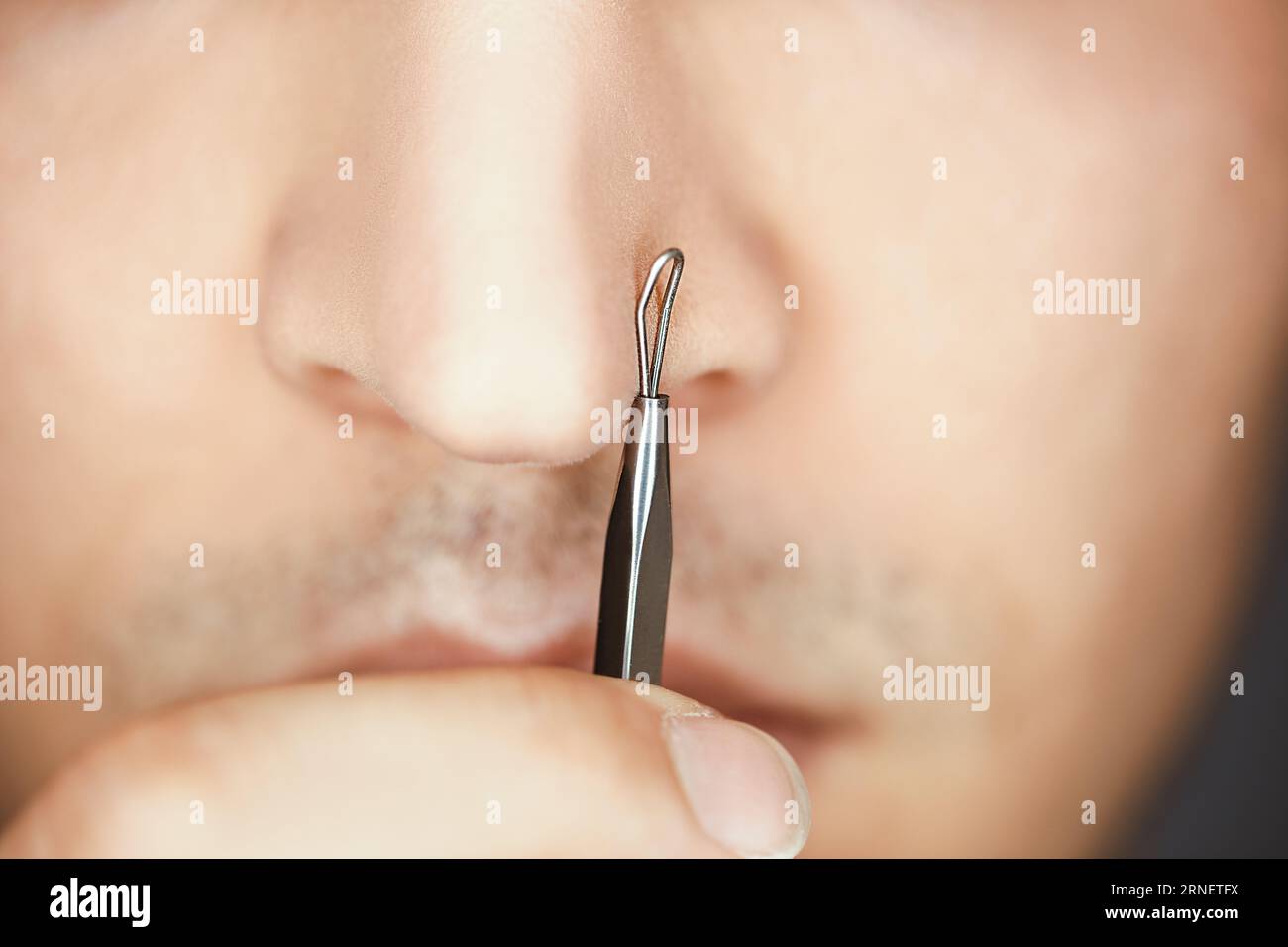 use pimple remover on male skin to care and clean pores and get blackheads out of nose by popping and squeezing them with extractor tool Stock Photo