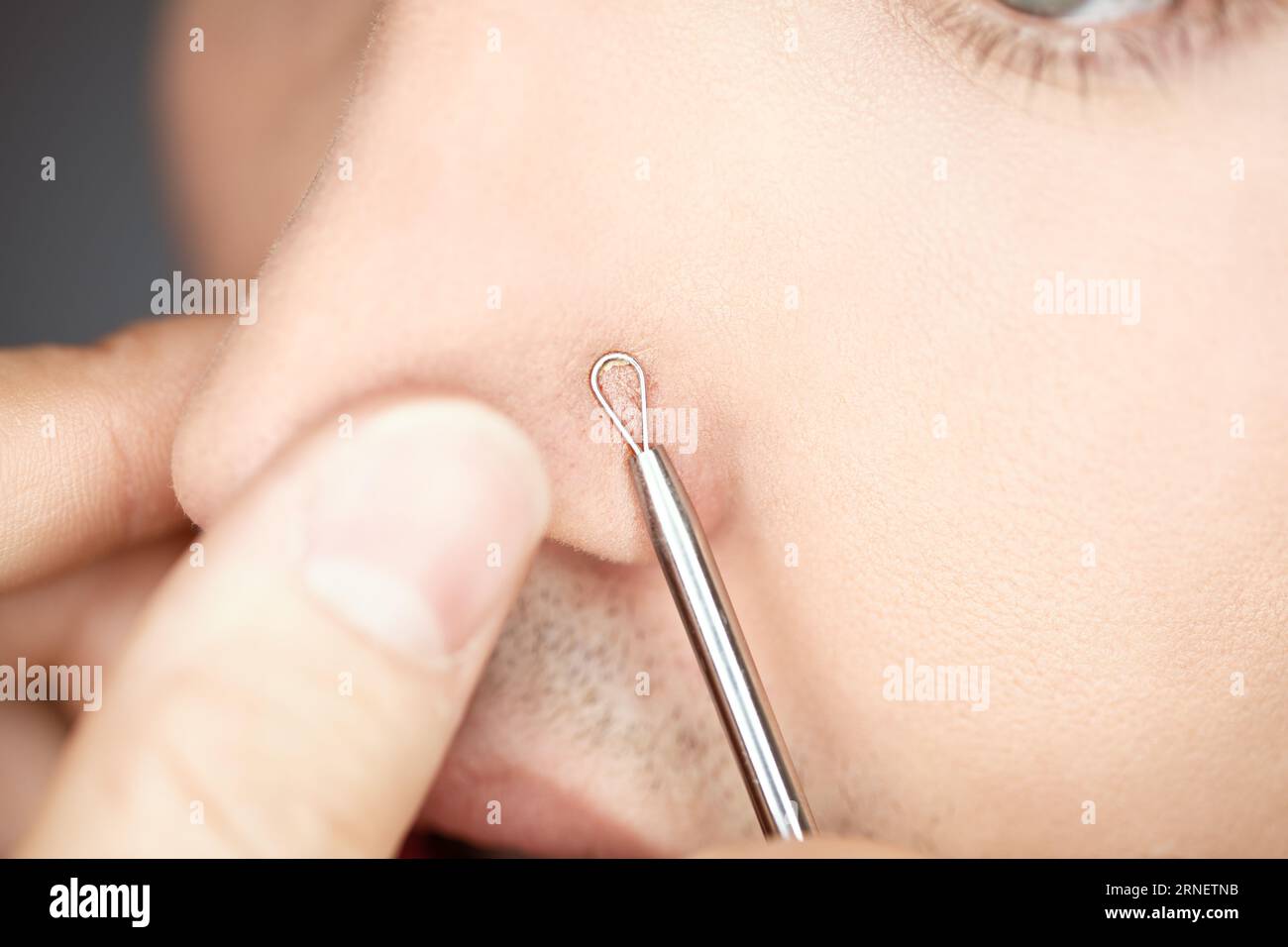 use pimple remover on male skin to care and clean pores and get blackheads out of nose by popping and squeezing them with extractor tool Stock Photo