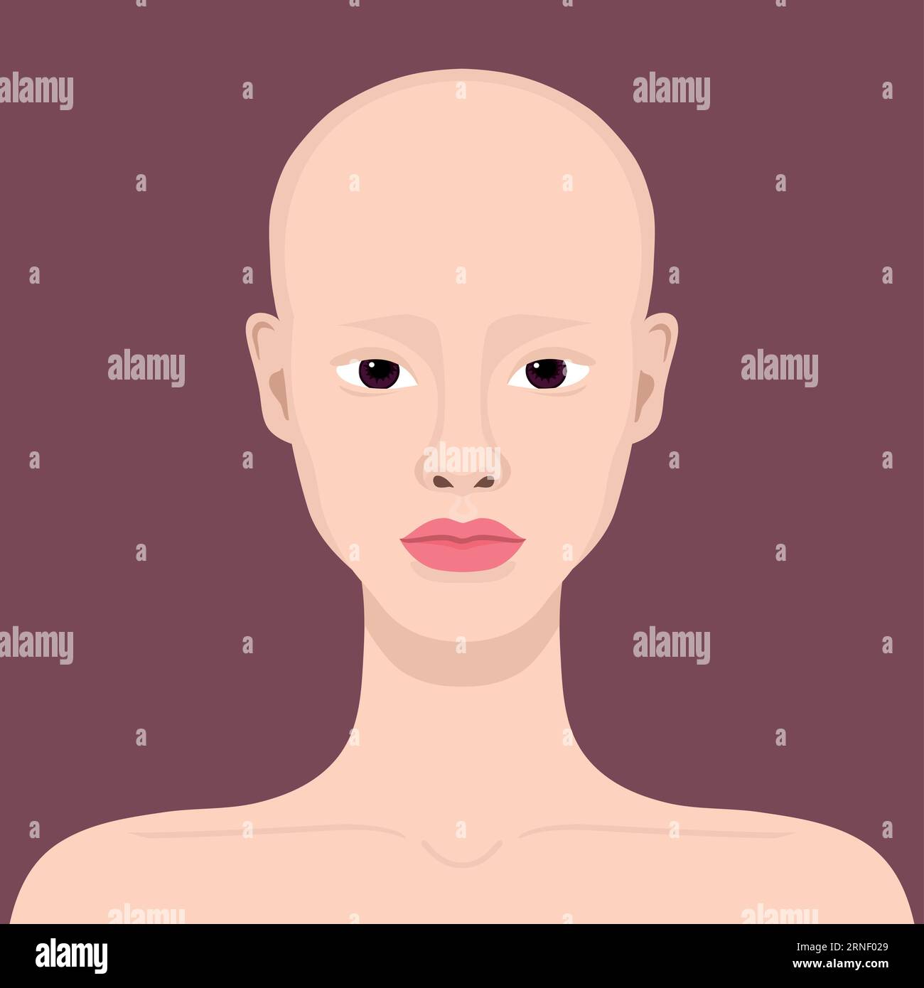 Young woman with alopecia. Beautiful bald girl. Alopecia areata. Vector illustration Stock Vector