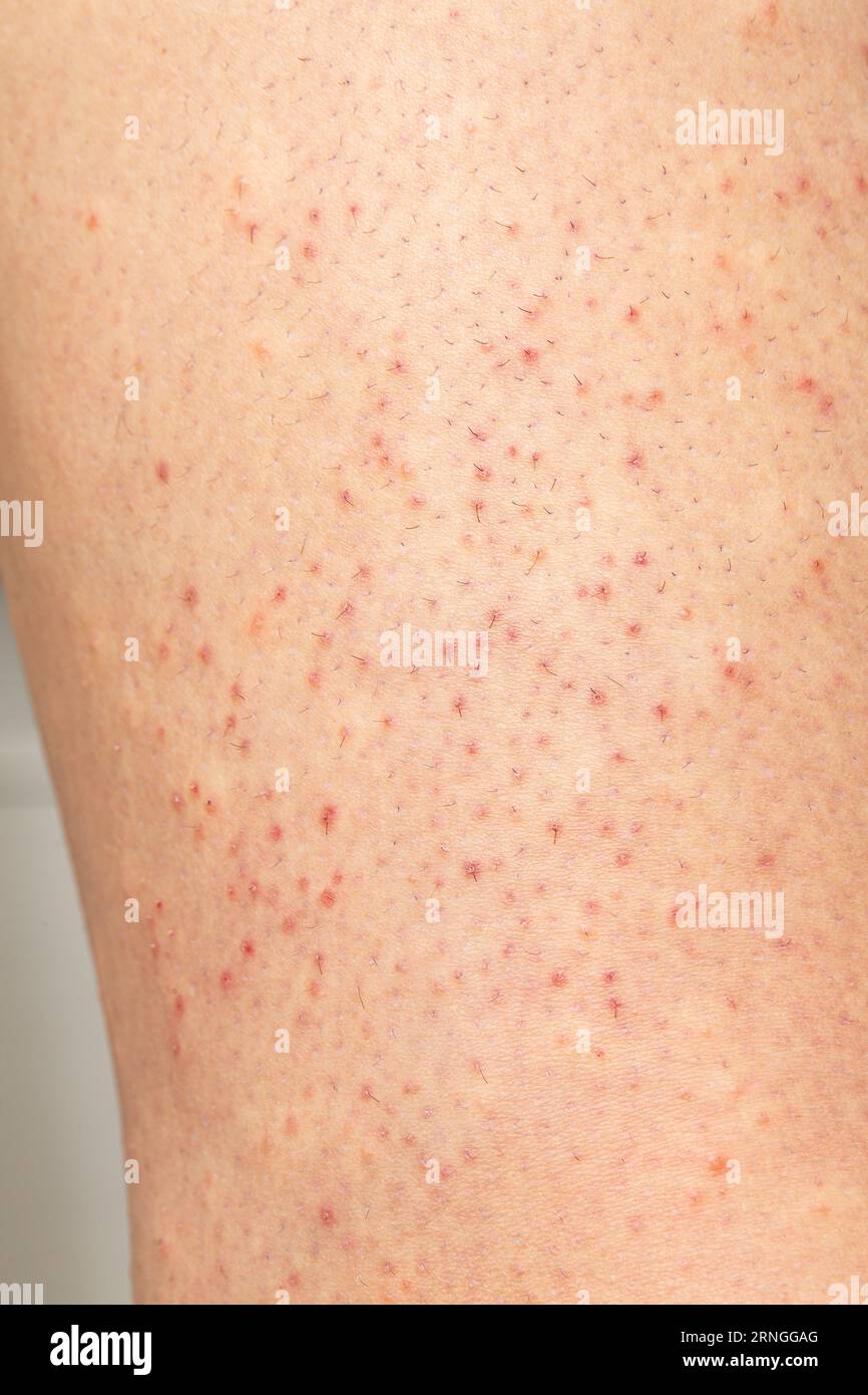 Localised Spots Macro of skin with folliculitis. Closeup of woman hair with irritation ...