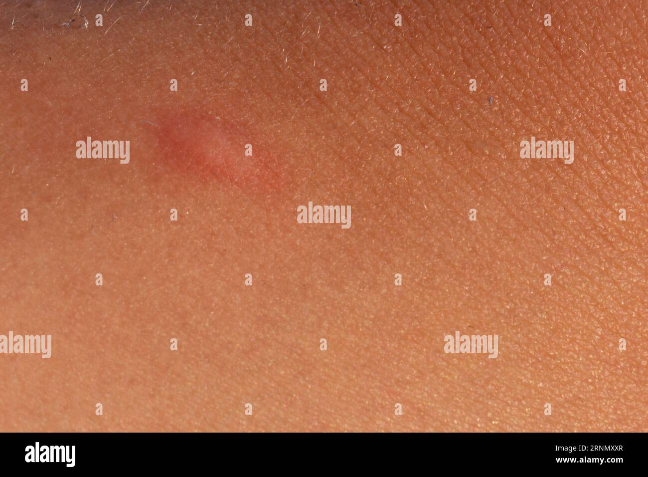 insect bite closeup on the skin. Allergic reaction. Diseases and
