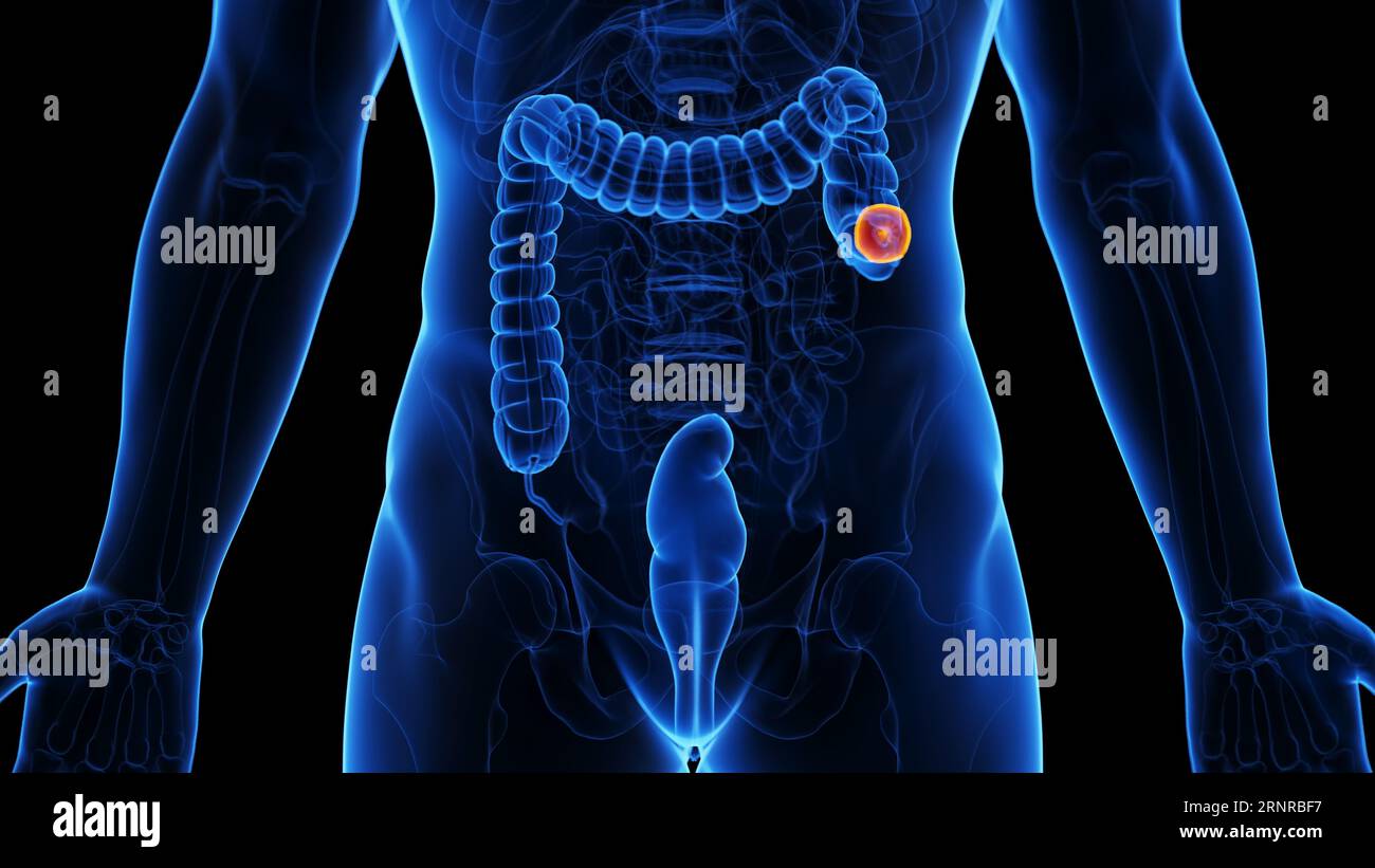 Colectomy, illustration Stock Photo