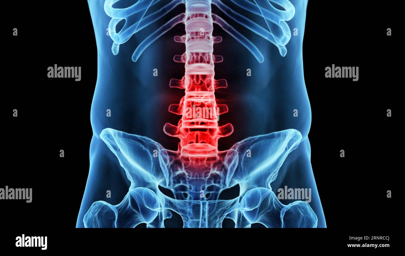 Painful lumbar spine, illustration Stock Photo - Alamy