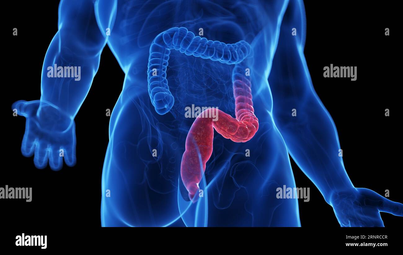 Ulcerative colitis, illustration Stock Photo - Alamy