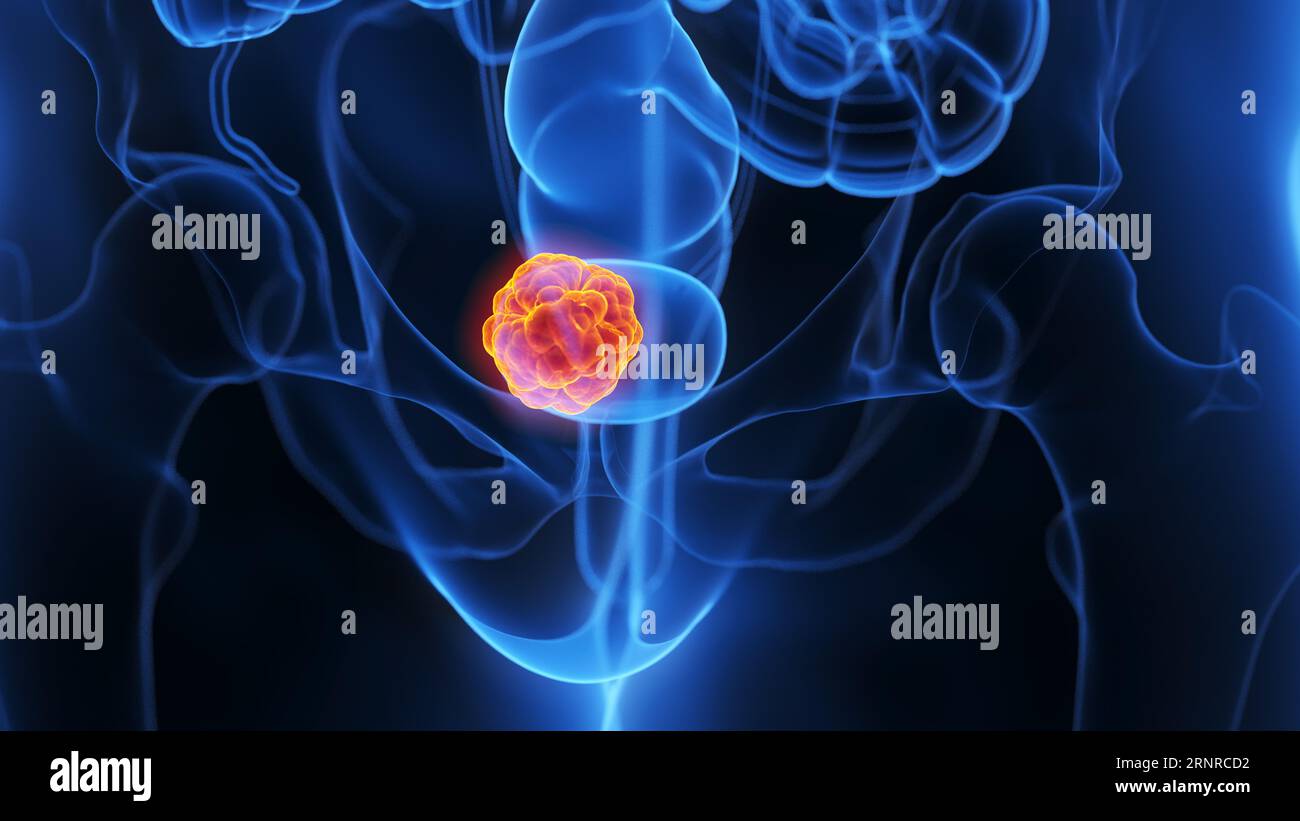 Bladder tumour, illustration Stock Photo - Alamy
