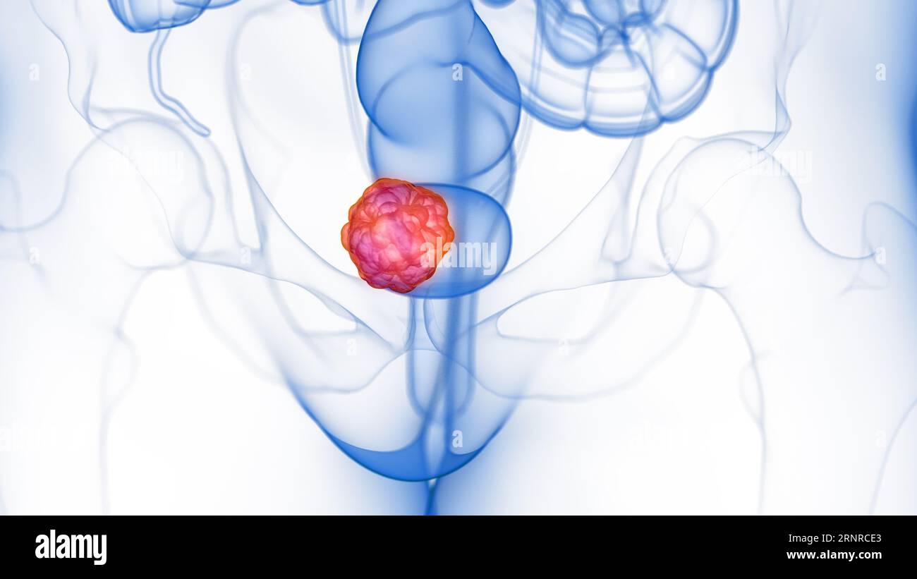 Bladder tumour, illustration Stock Photo - Alamy