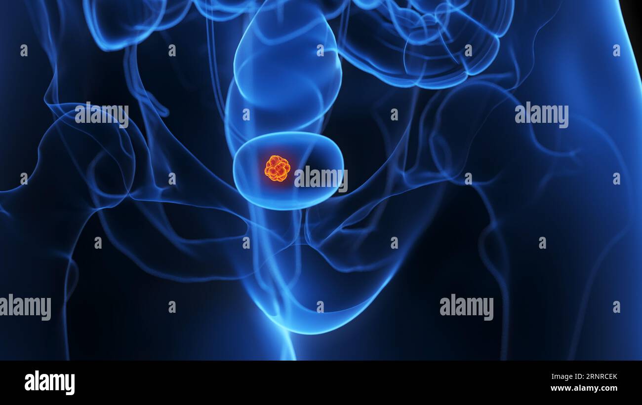 Bladder tumour, illustration Stock Photo - Alamy