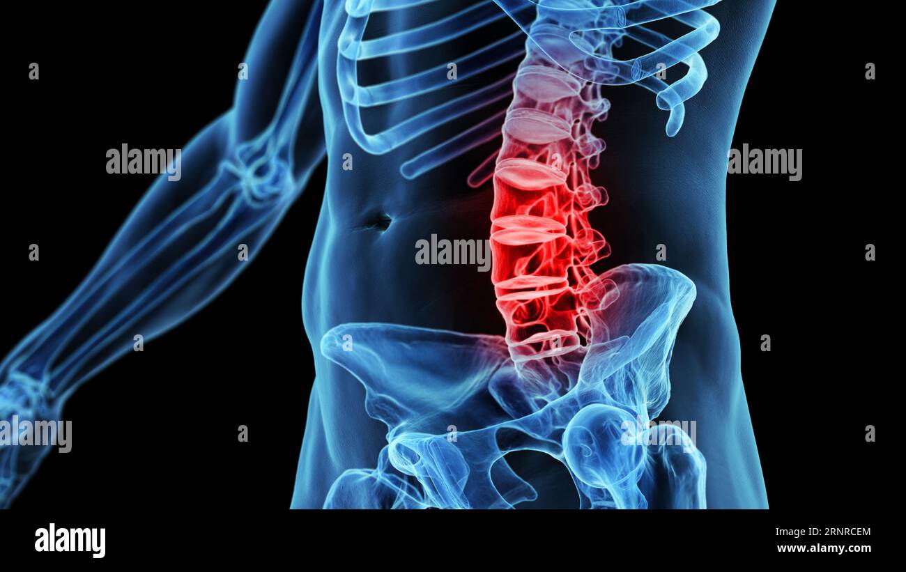 Painful lumbar spine, illustration Stock Photo - Alamy