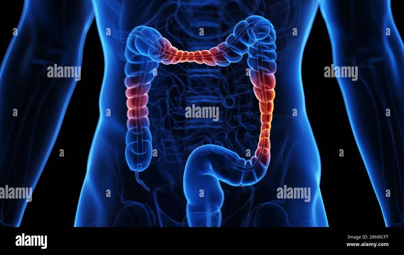 Inflammatory bowel disease, illustration Stock Photo Alamy