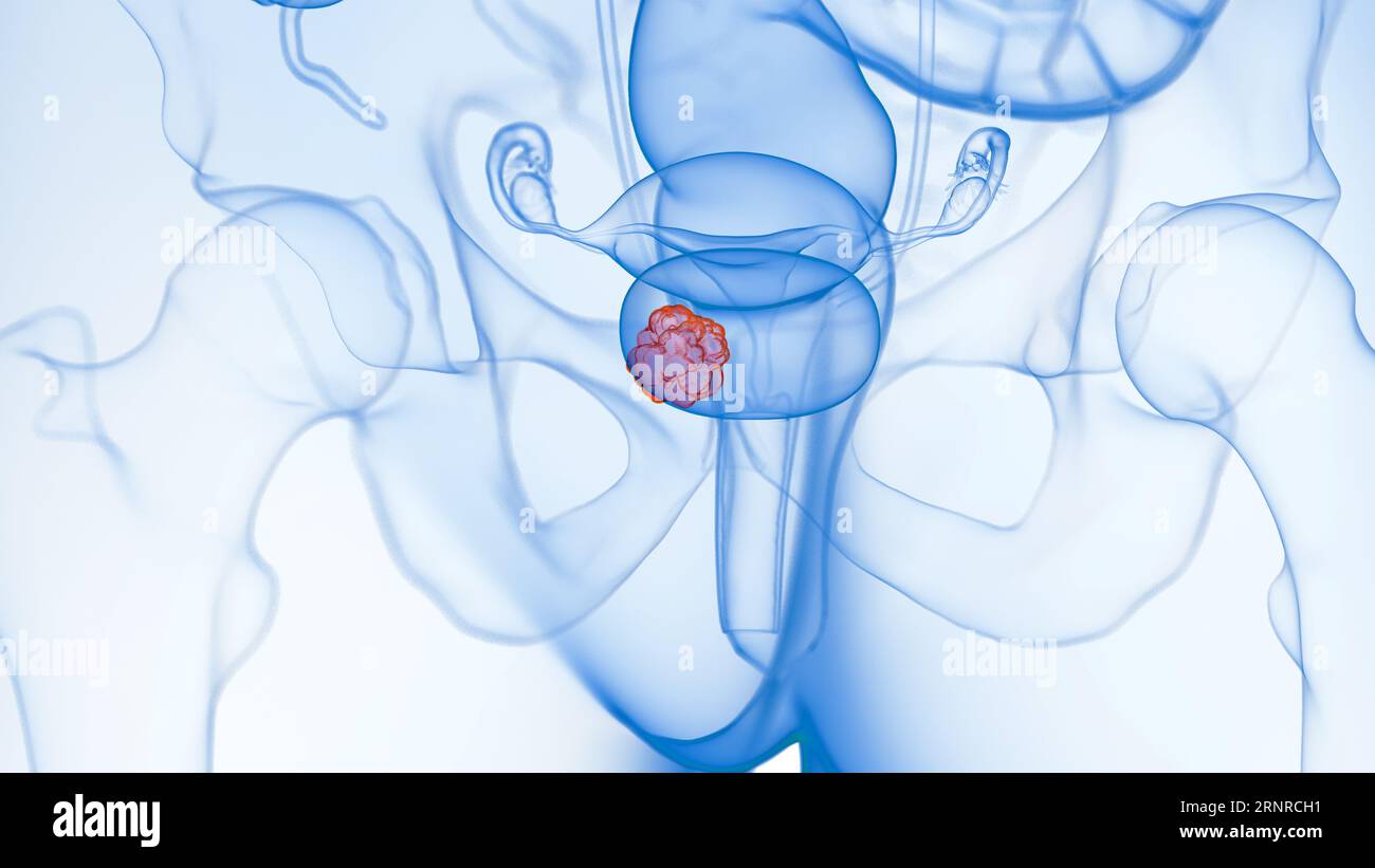 Bladder tumour, illustration Stock Photo - Alamy