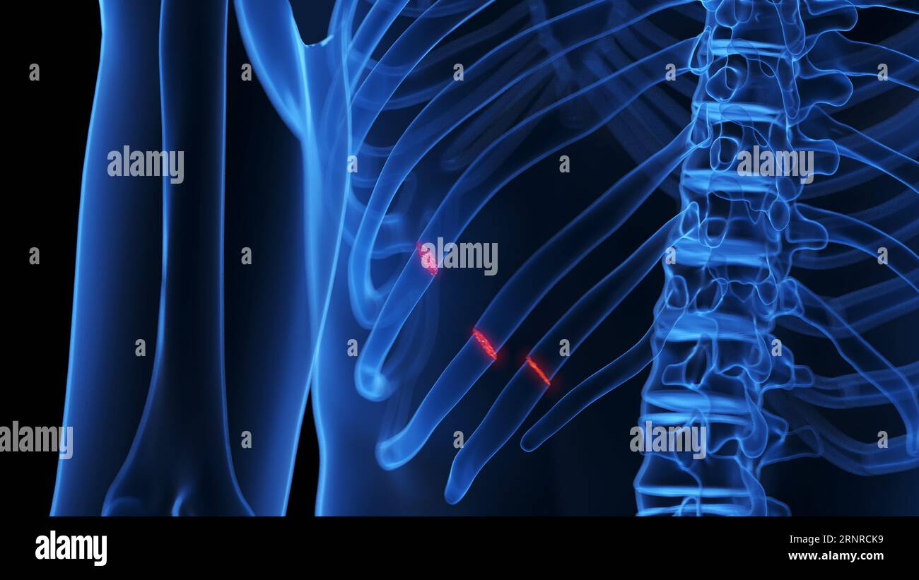Broken ribs, illustration Stock Photo Alamy