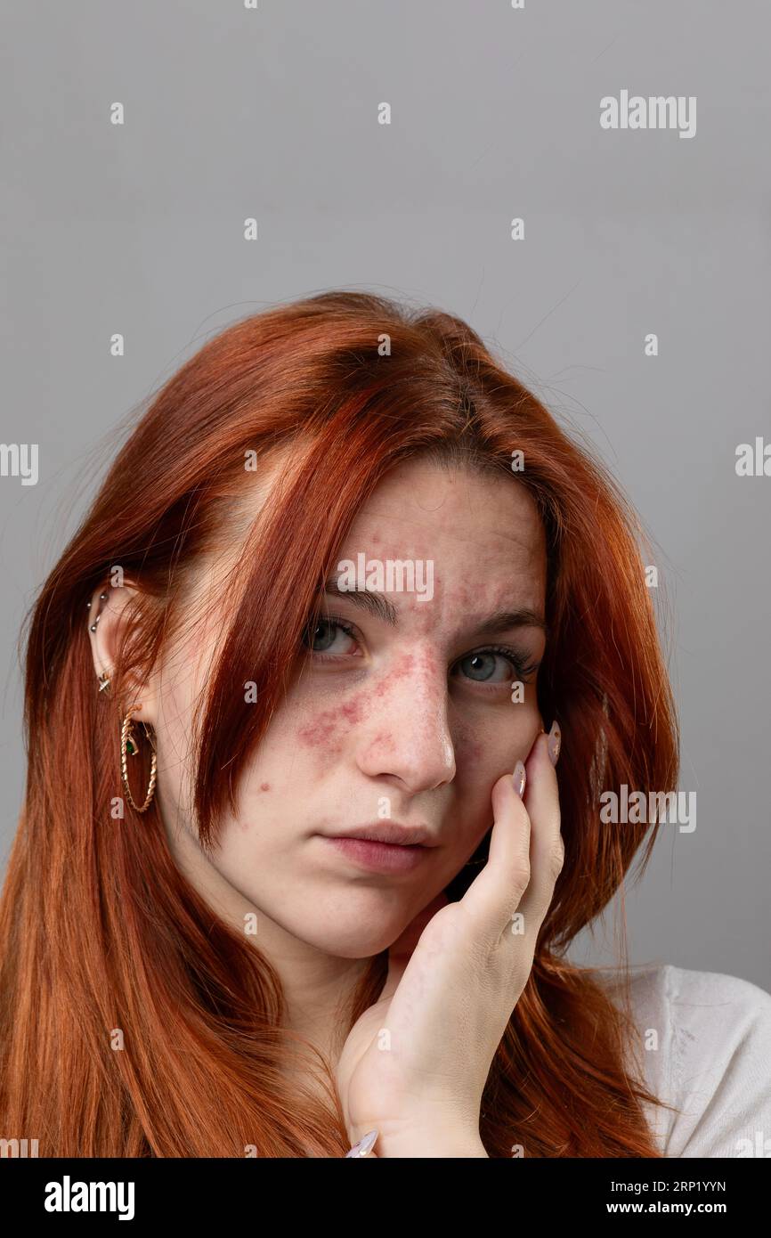 Young woman with acute skin rash on her face. Dermatological problems due to allergy, hypersensitivity or anaphylactic shock. Red skin with rash or ec Stock Photo