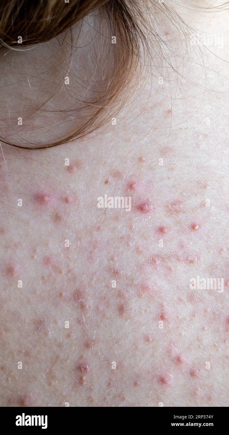 woman back with acne, red spots, skin disease Stock Photo Alamy