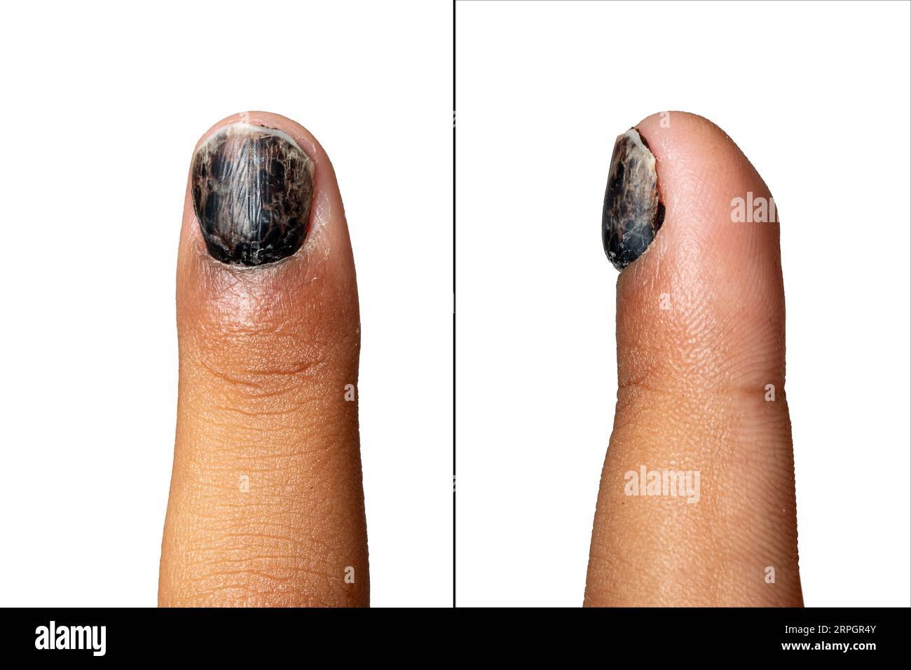 Black nail due to crush trauma. Hematoma causing the nail to