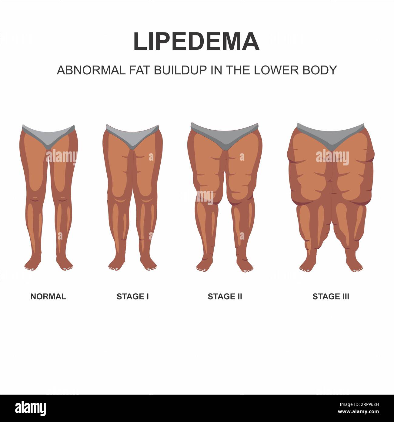 Lipedema stages illustration Stock Photo - Alamy